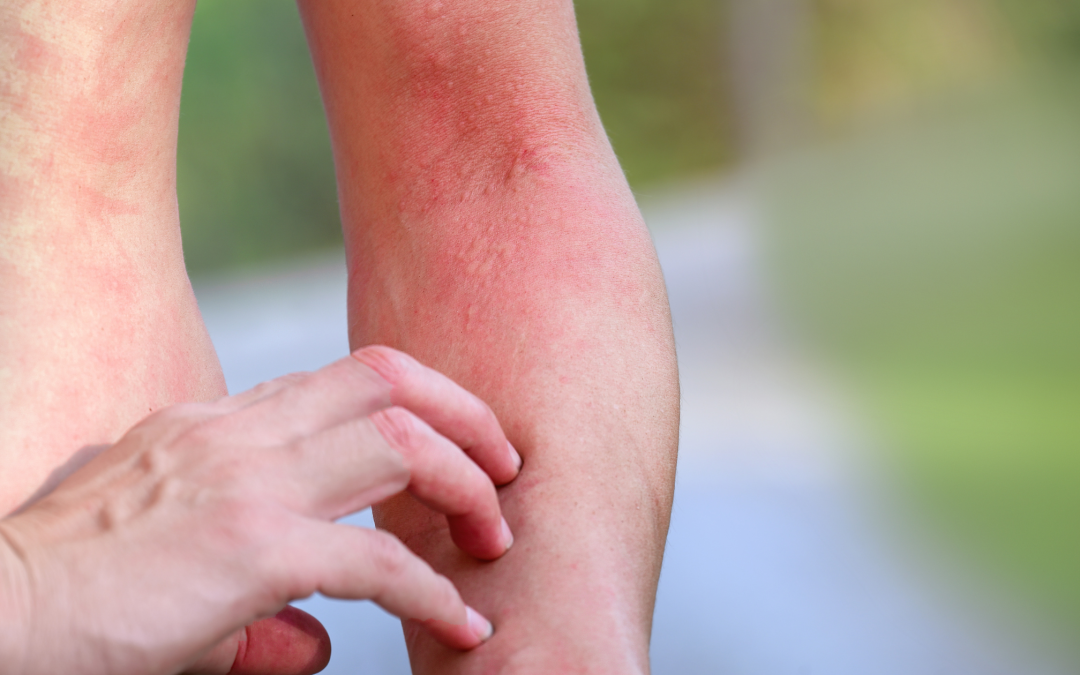 Am I Dealing with a Poison Ivy Rash?