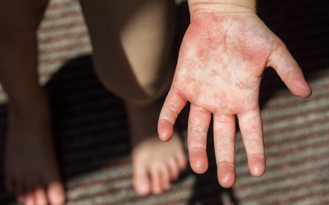 What to know about Hand, Foot, and Mouth Disease
